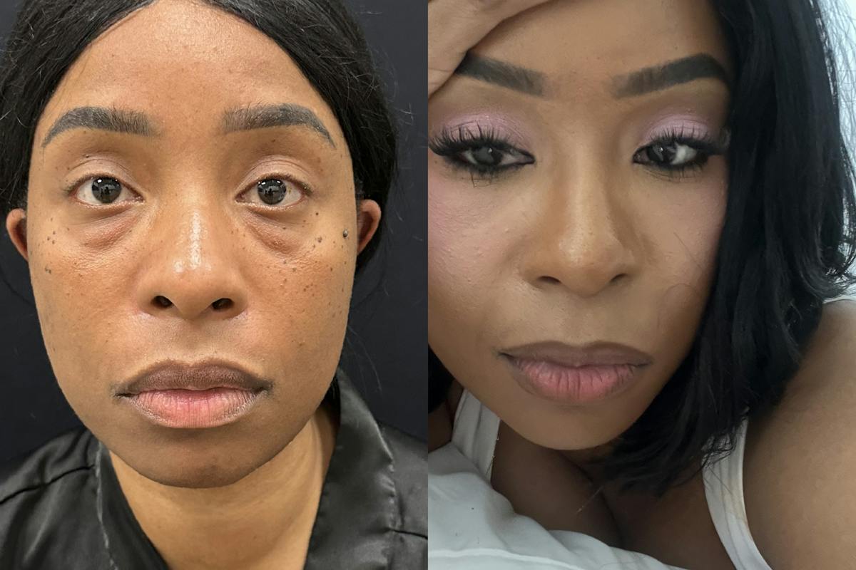 Lower Blepharoplasty Before & After Gallery - Patient 281499 - Image 1