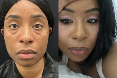 Lower Blepharoplasty Before & After Gallery - Patient 281499 - Image 1