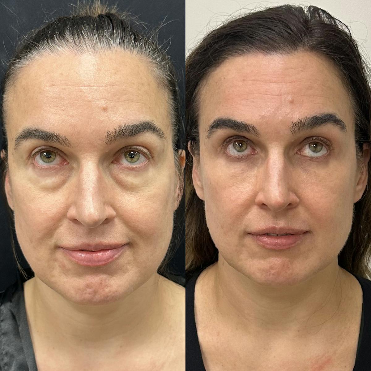 Lower Blepharoplasty Before & After Gallery - Patient 397841 - Image 2