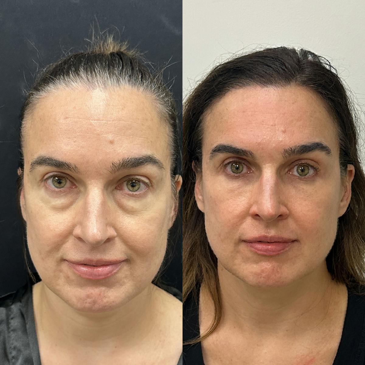 Lower Blepharoplasty Before & After Gallery - Patient 397841 - Image 1