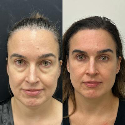 Lower Blepharoplasty Before & After Gallery - Patient 397841 - Image 1