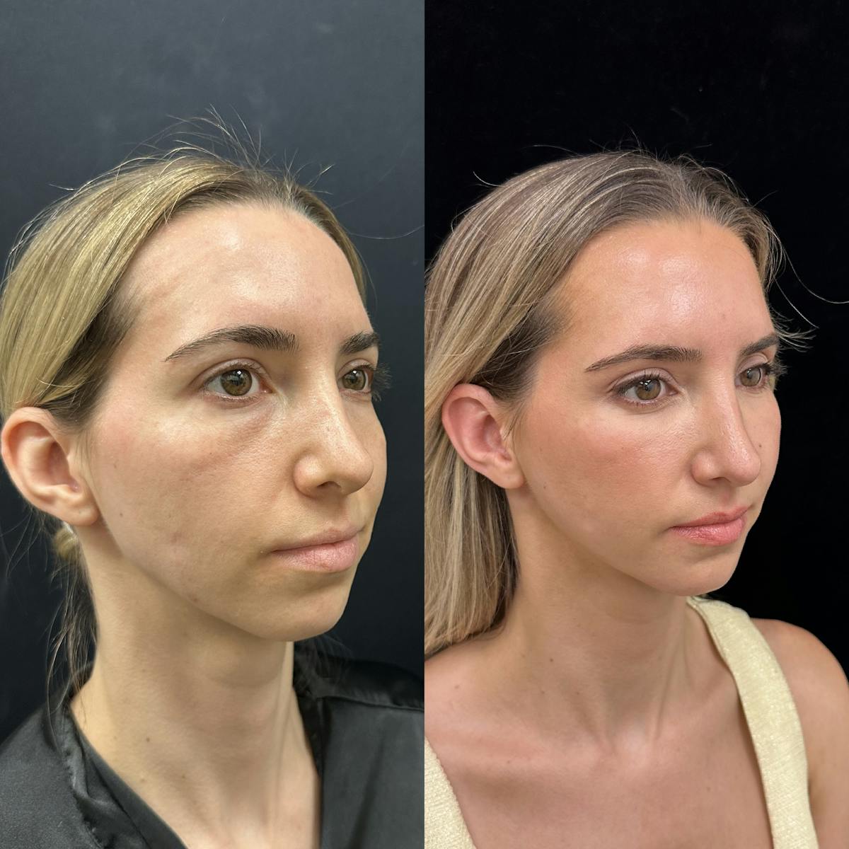 Lower Blepharoplasty Before & After Gallery - Patient 159322 - Image 2