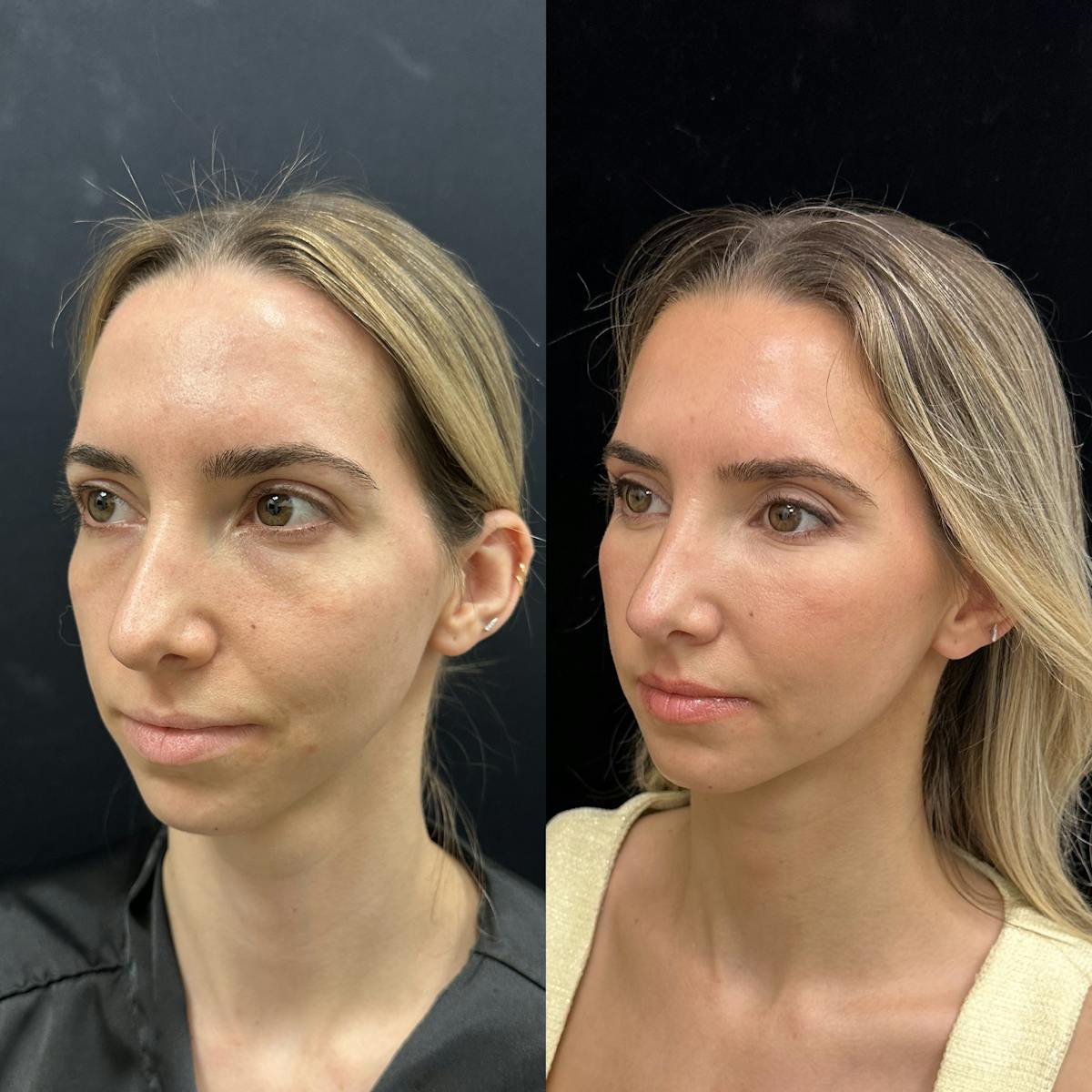 Lower Blepharoplasty Before & After Gallery - Patient 159322 - Image 3