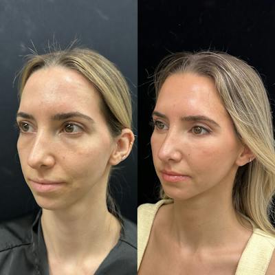 Lower Blepharoplasty Before & After Gallery - Patient 159322 - Image 3