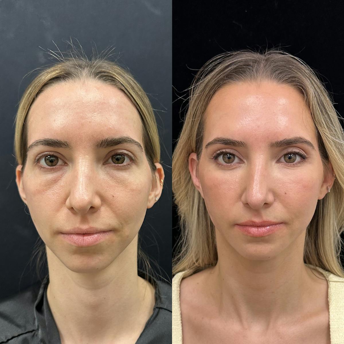 Lower Blepharoplasty Before & After Gallery - Patient 159322 - Image 1