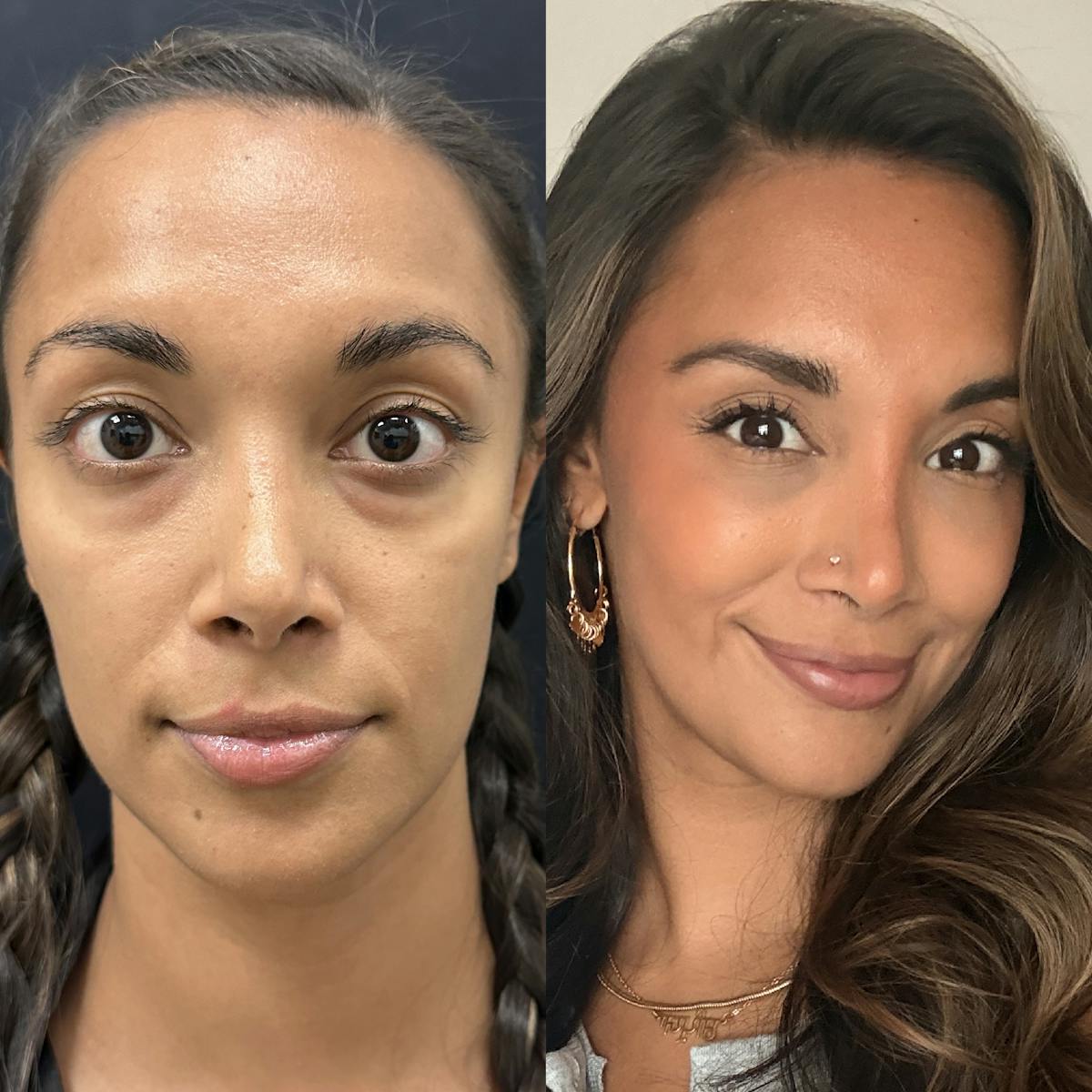 Lower Blepharoplasty Before & After Gallery - Patient 415030 - Image 3