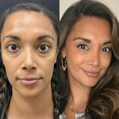 Lower Blepharoplasty Before & After Gallery - Patient 415030 - Image 3