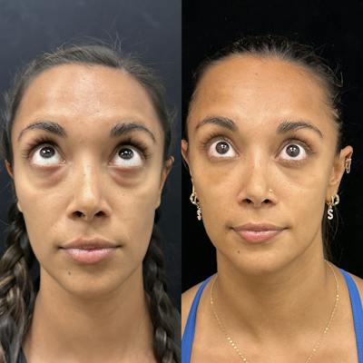 Lower Blepharoplasty Before & After Gallery - Patient 415030 - Image 2
