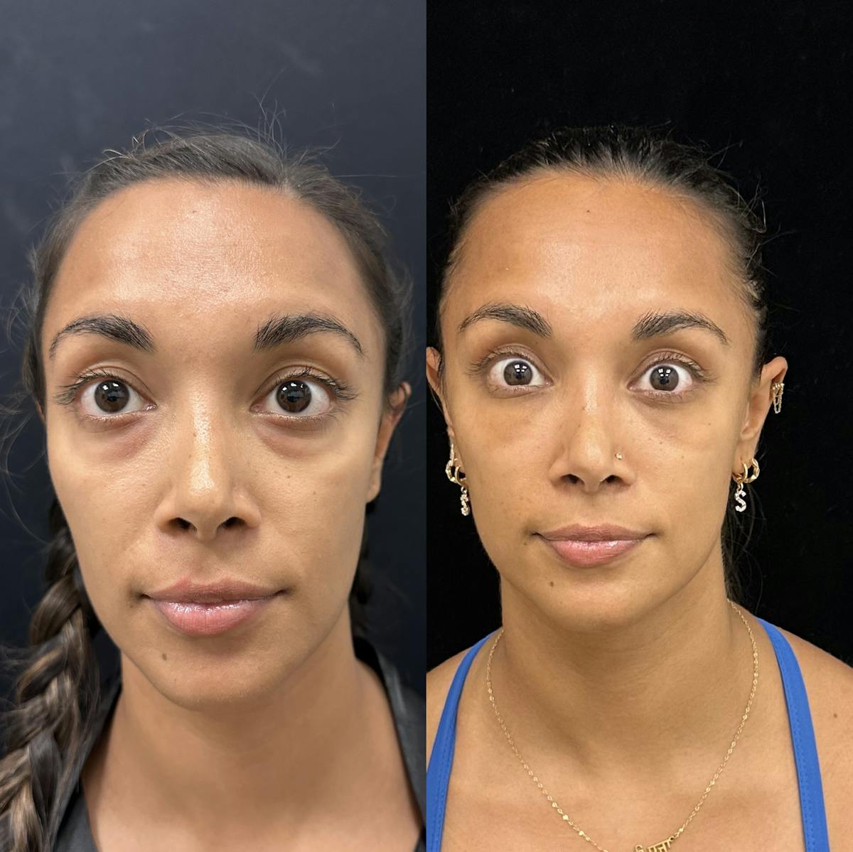Lower Blepharoplasty Before & After Gallery - Patient 415030 - Image 1