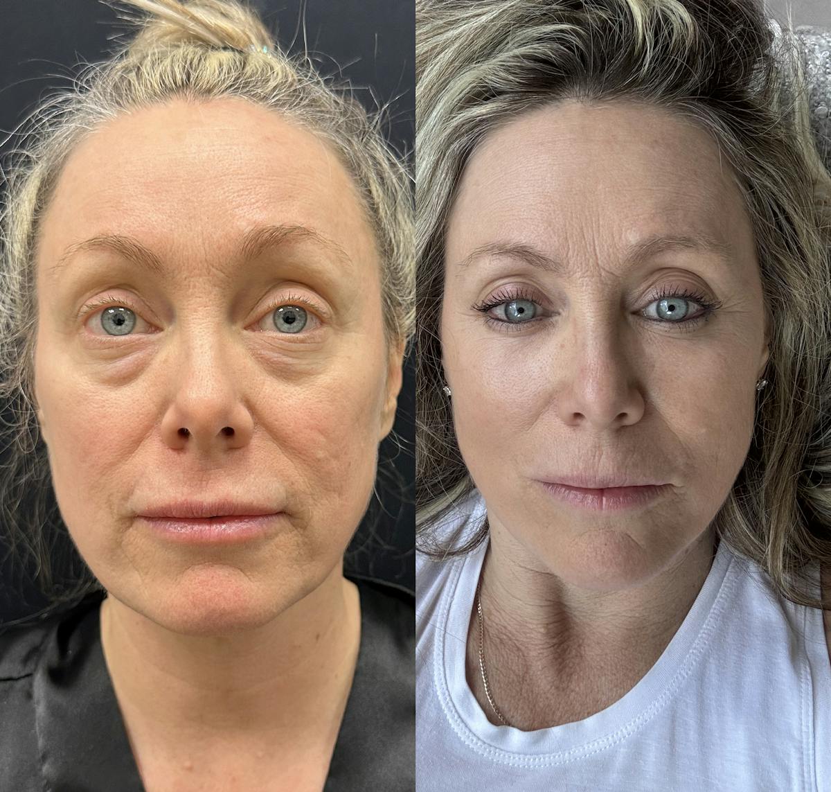 Lower Blepharoplasty Before & After Gallery - Patient 418267 - Image 1