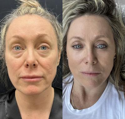 Lower Blepharoplasty Before & After Gallery - Patient 418267 - Image 1