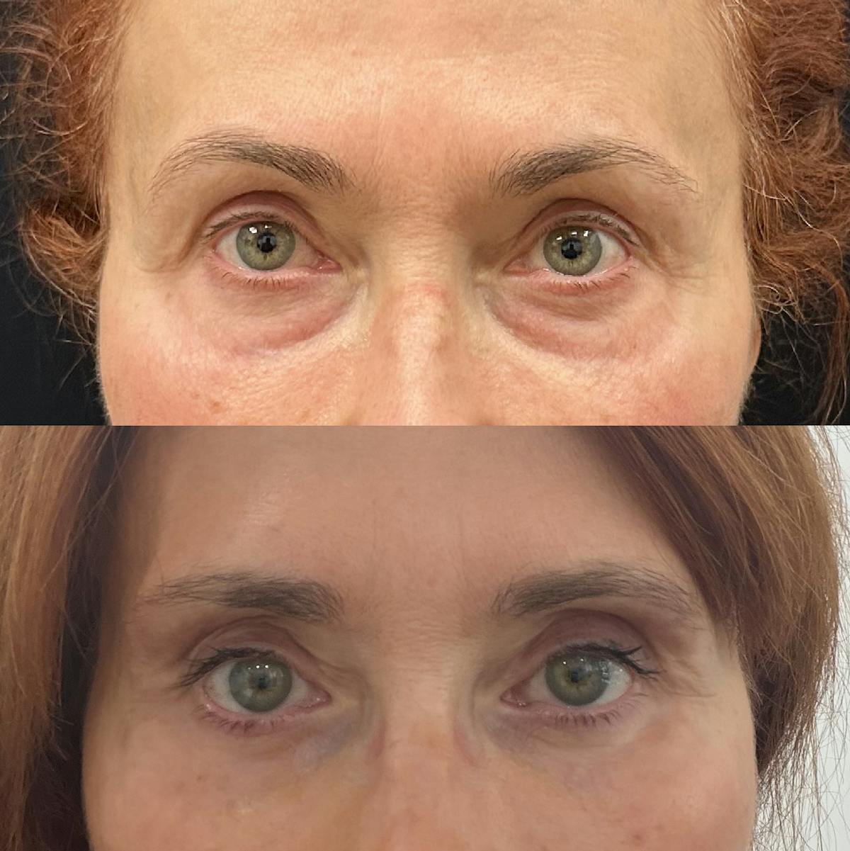 Lower Blepharoplasty Before & After Gallery - Patient 245267 - Image 1