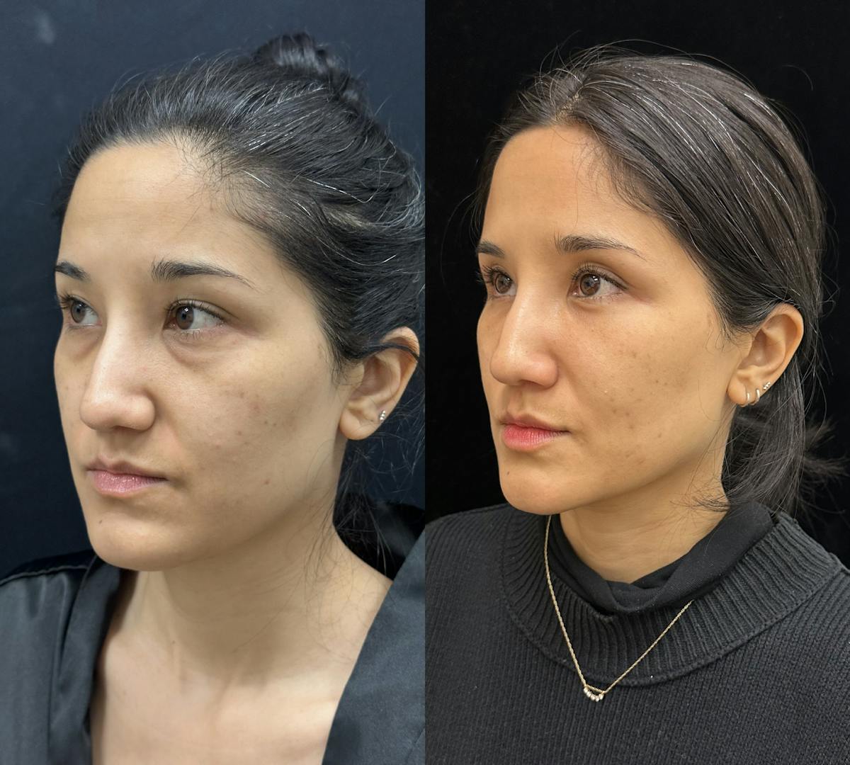 Lower Blepharoplasty Before & After Gallery - Patient 191137 - Image 2