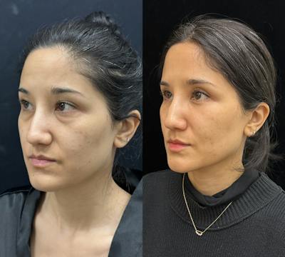 Lower Blepharoplasty Before & After Gallery - Patient 191137 - Image 2