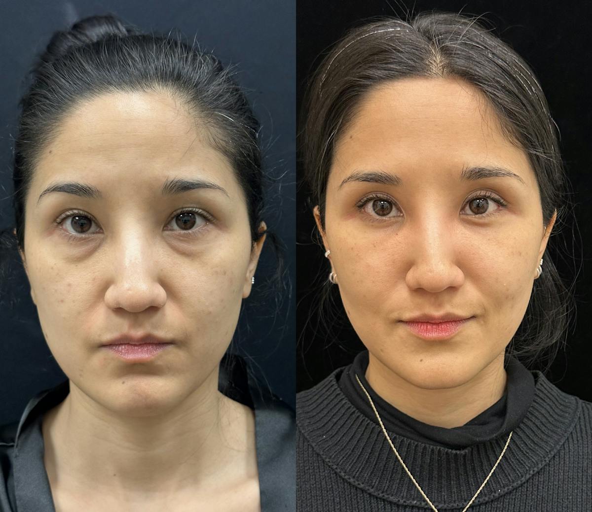 Lower Blepharoplasty Before & After Gallery - Patient 191137 - Image 1
