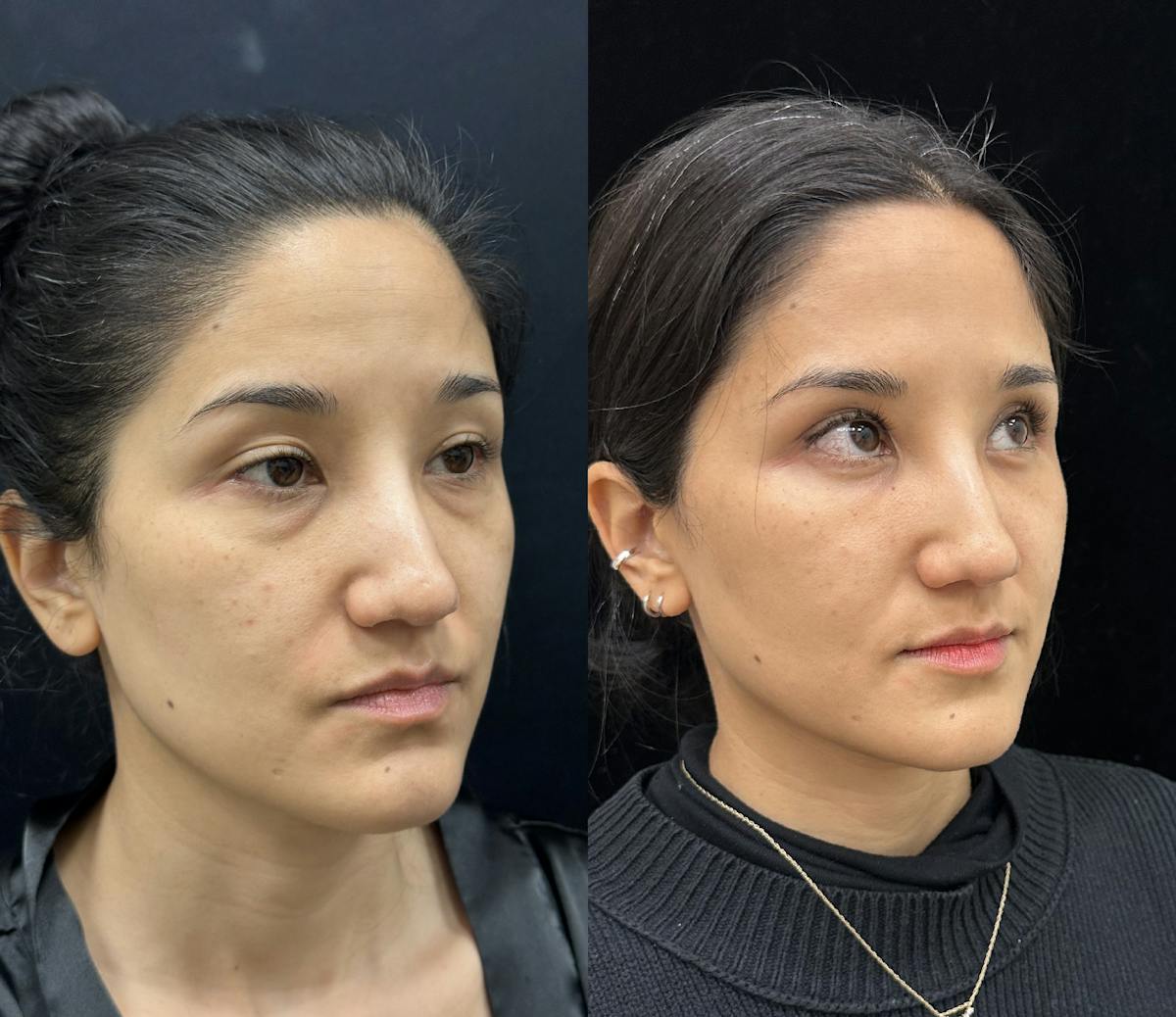 Lower Blepharoplasty Before & After Gallery - Patient 191137 - Image 3