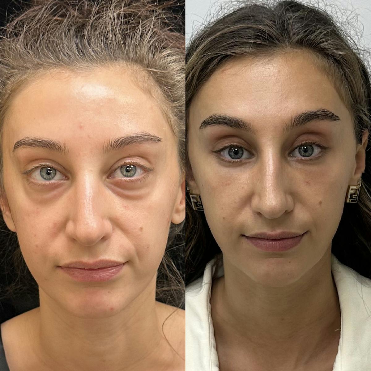 Lower Blepharoplasty Before & After Gallery - Patient 349232 - Image 1