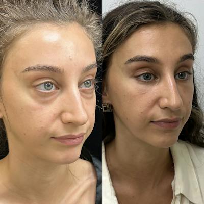 Lower Blepharoplasty Before & After Gallery - Patient 349232 - Image 2