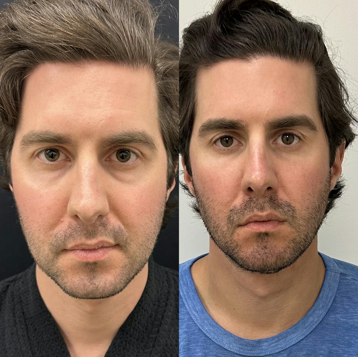 Lower Blepharoplasty Before & After Gallery - Patient 149665 - Image 1