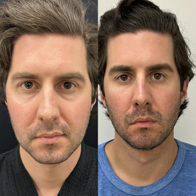Lower Blepharoplasty Before & After Gallery - Patient 149665 - Image 1