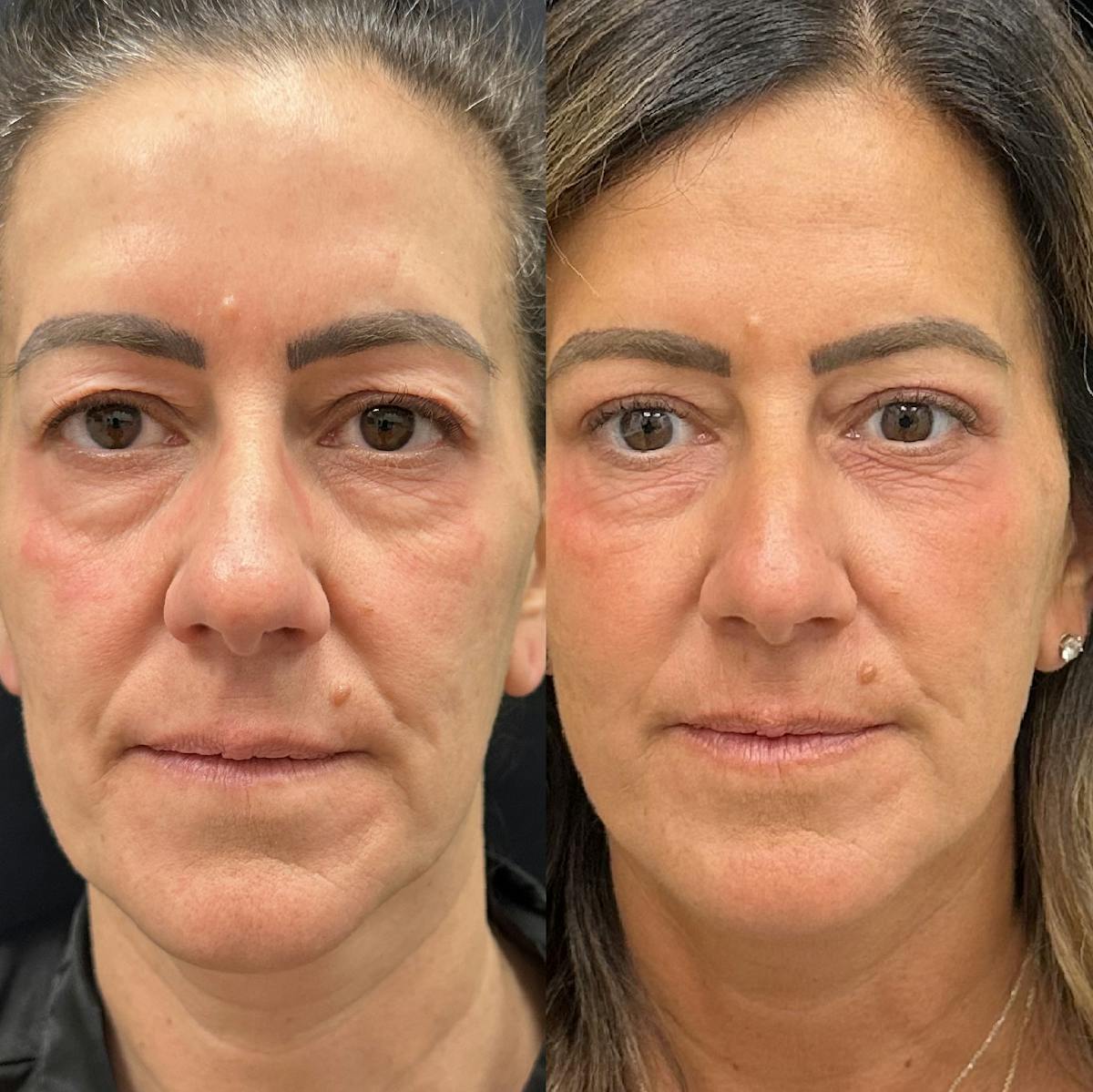  Upper Blepharoplasty Before & After Gallery - Patient 410183 - Image 1