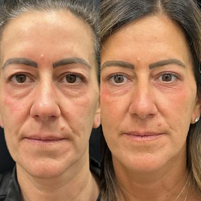 Upper Blepharoplasty Before & After Gallery - Patient 410183 - Image 1