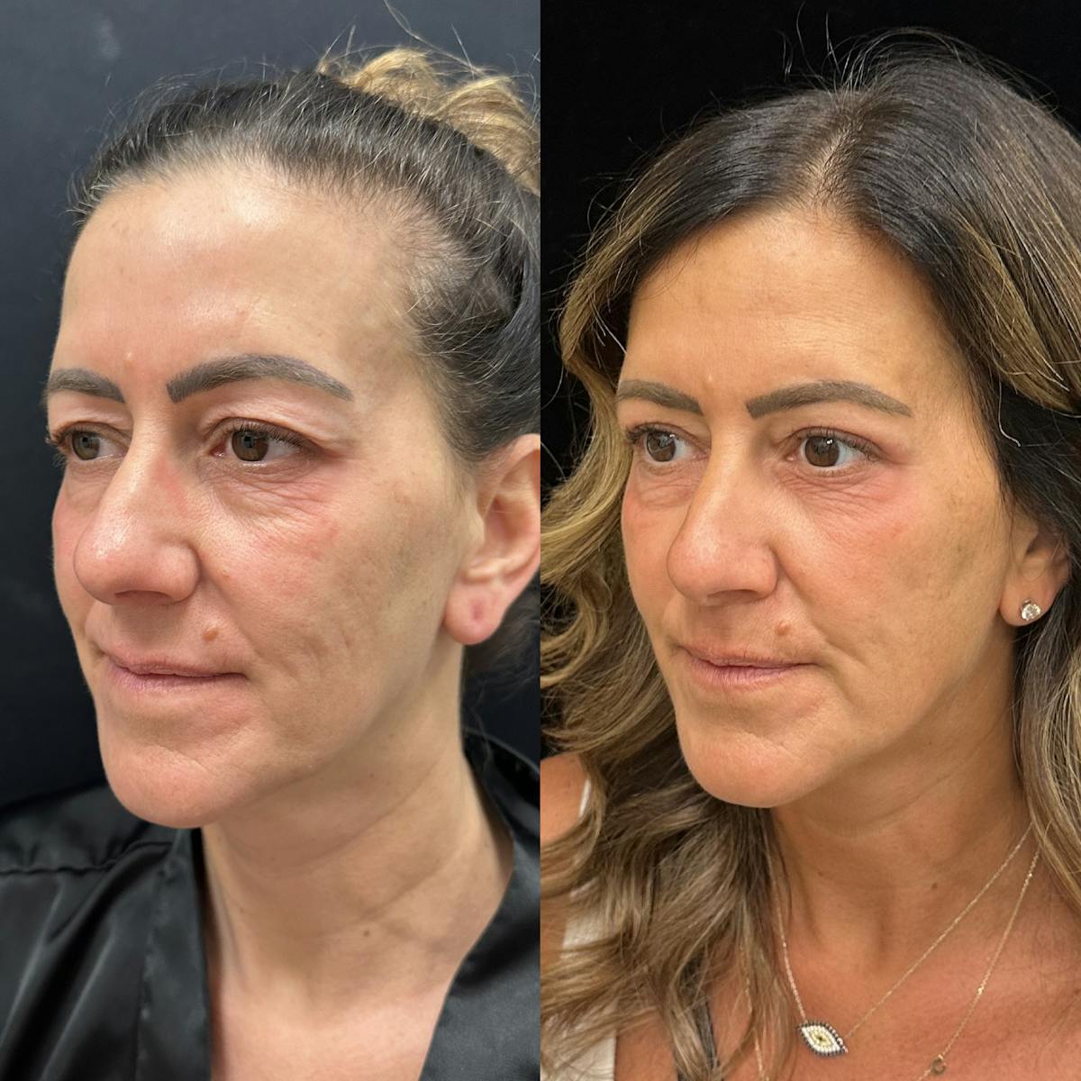  Upper Blepharoplasty Before & After Gallery - Patient 410183 - Image 2