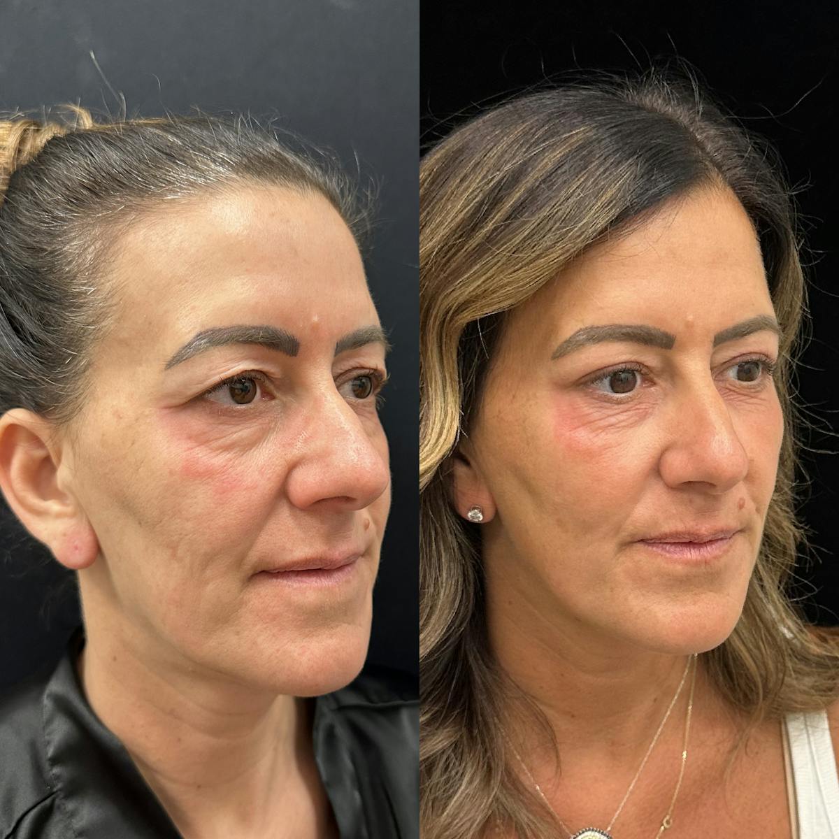  Upper Blepharoplasty Before & After Gallery - Patient 410183 - Image 3