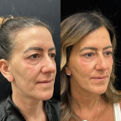 Upper Blepharoplasty Before & After Gallery - Patient 410183 - Image 3