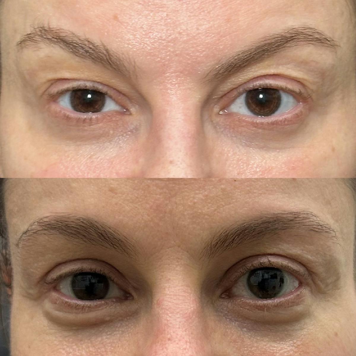  Upper Blepharoplasty Before & After Gallery - Patient 244549 - Image 1
