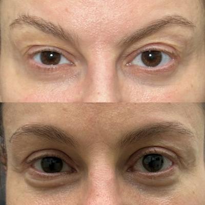 Upper Blepharoplasty Before & After Gallery - Patient 244549 - Image 1