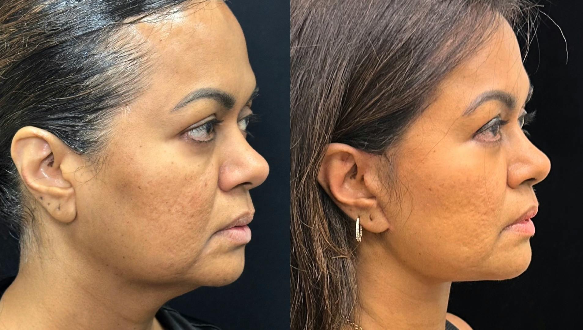 Actual patient before and after photos showing changes in facial contours and jawline definition from a side profile.