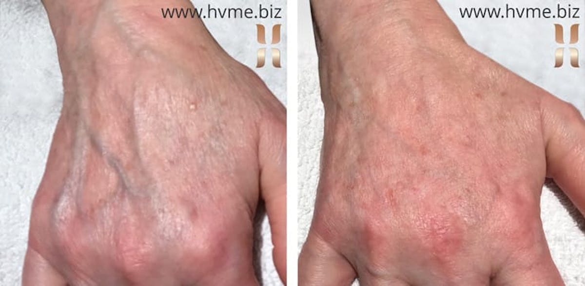 Restylane Before & After Gallery - Patient 415760 - Image 1