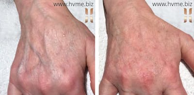 Restylane Before & After Gallery - Patient 415760 - Image 1