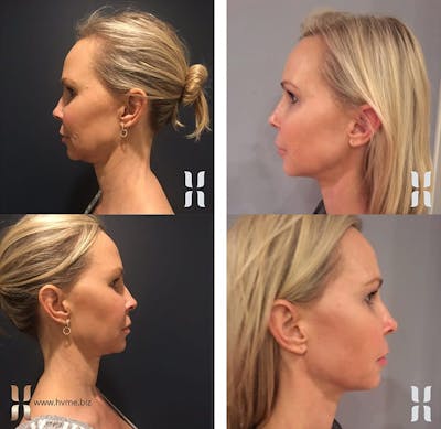Kybella Before & After Gallery - Patient 342769 - Image 1