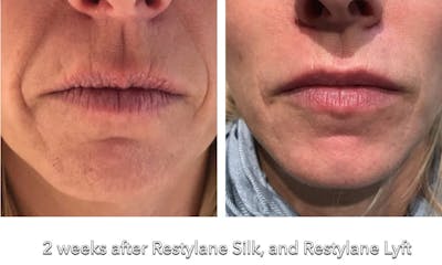 Restylane Before & After Gallery - Patient 347539 - Image 1