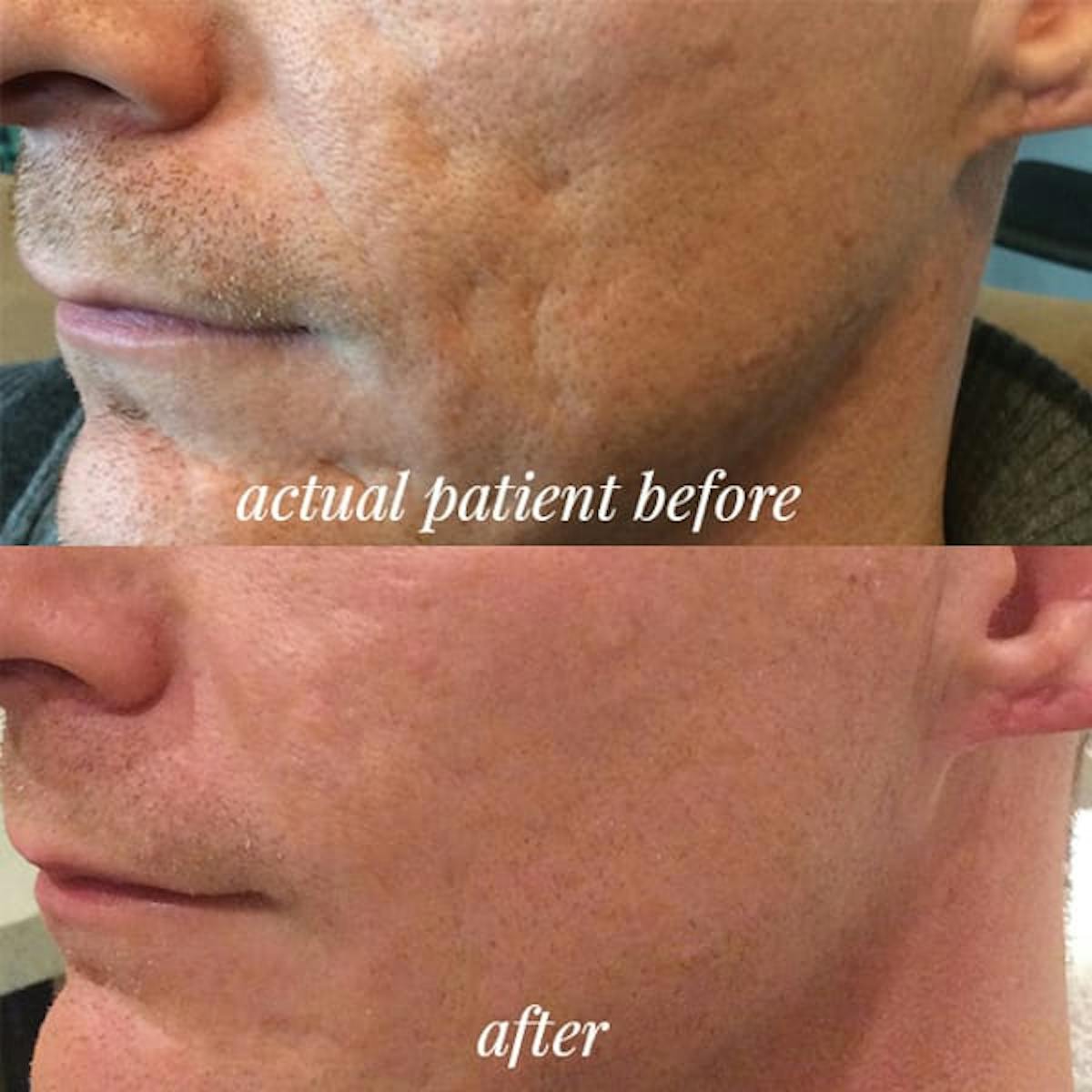 Bellafill Before & After Gallery - Patient 240313 - Image 1