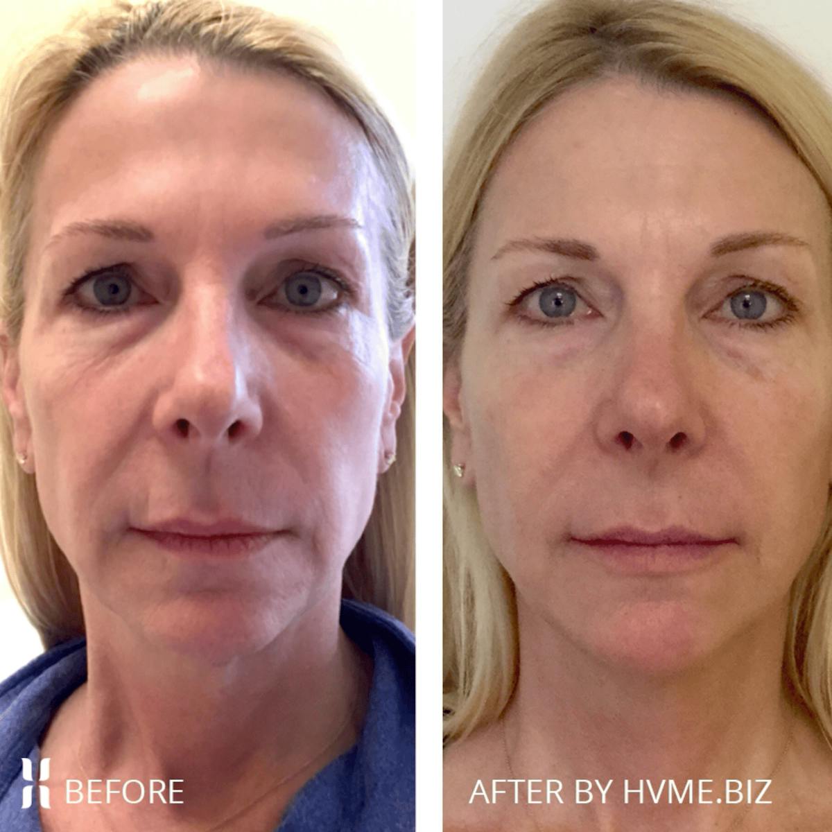 Sculptra Before & After Gallery - Patient 233874 - Image 1