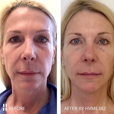 Sculptra Before & After Gallery - Patient 233874 - Image 1