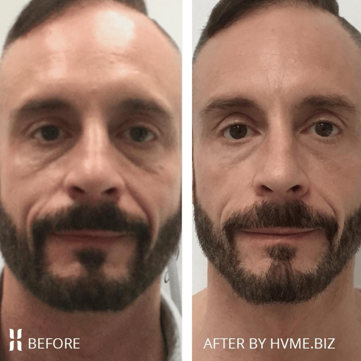 Sculptra Before & After Gallery - Patient 374541 - Image 1