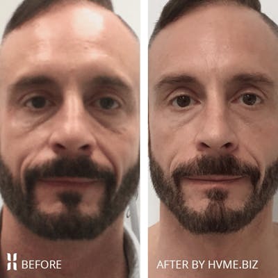 Sculptra Before & After Gallery - Patient 374541 - Image 1