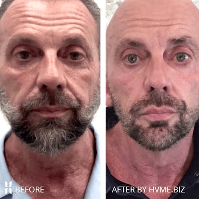 Sculptra Before & After Gallery - Patient 408384 - Image 1