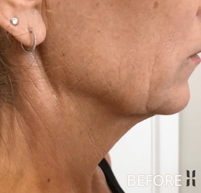 Scarlet RF Before & After Gallery - Patient 928048 - Image 1