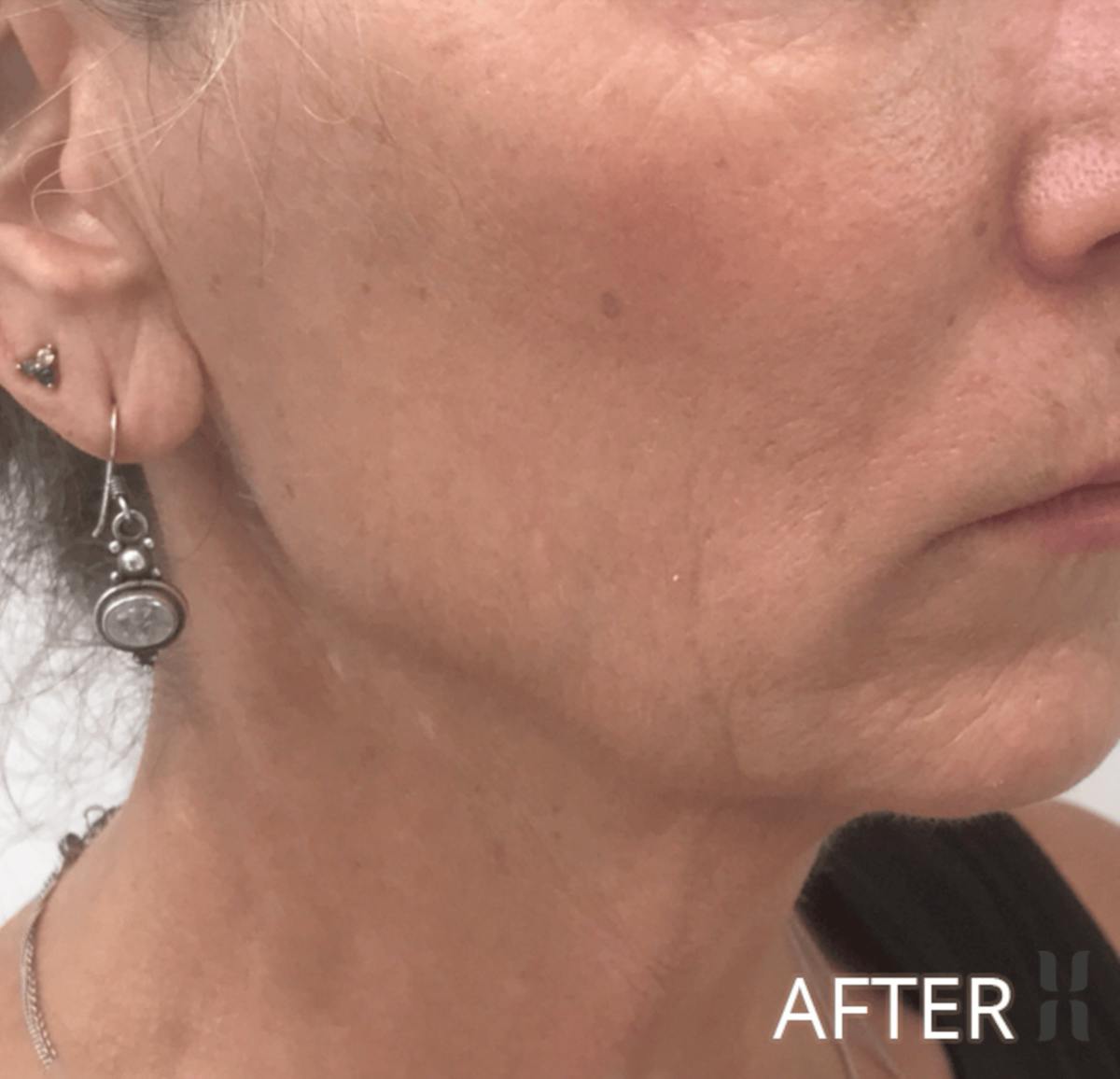 Scarlet RF Before & After Gallery - Patient 928048 - Image 4