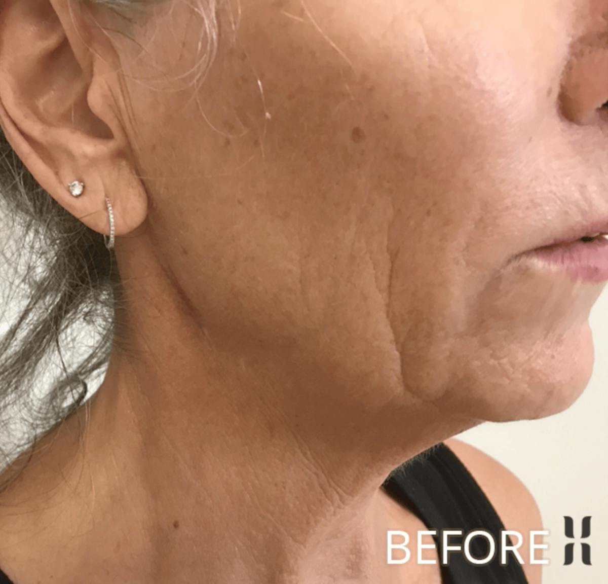 Scarlet RF Before & After Gallery - Patient 928048 - Image 3