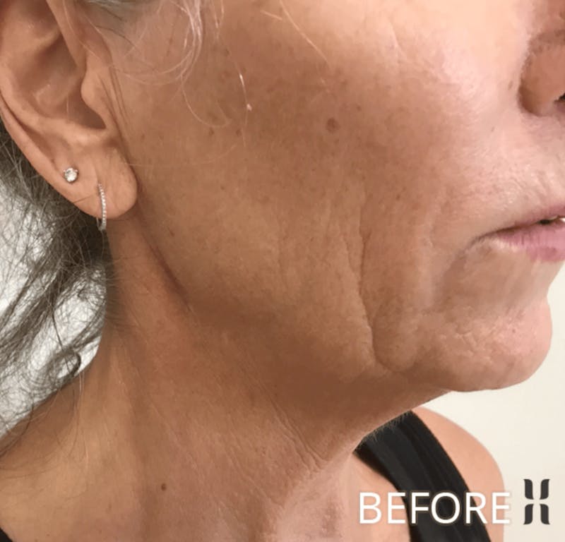 Scarlet RF Before & After Gallery - Patient 928048 - Image 3