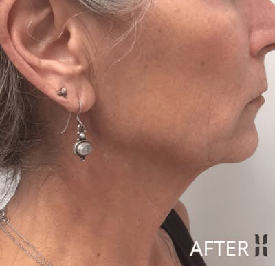 Scarlet RF Before & After Gallery - Patient 928048 - Image 2