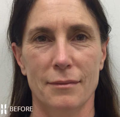 Sculptra Before & After Gallery - Patient 116722 - Image 1