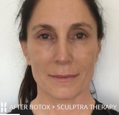 BOTOX Before & After Gallery - Patient 104912 - Image 1