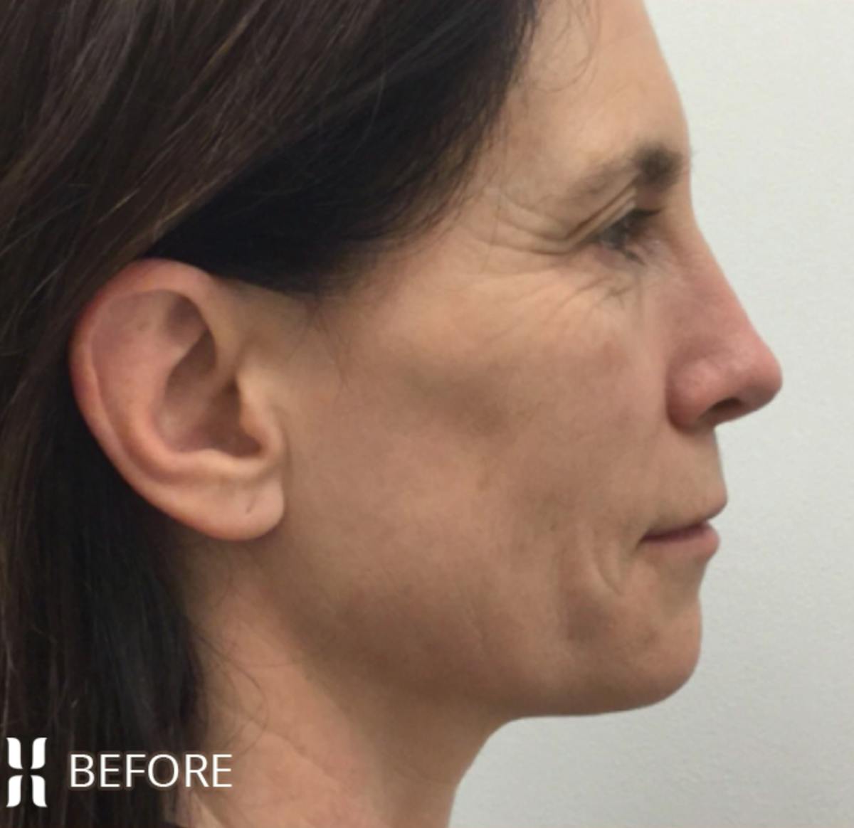 BOTOX Before & After Gallery - Patient 104912 - Image 3